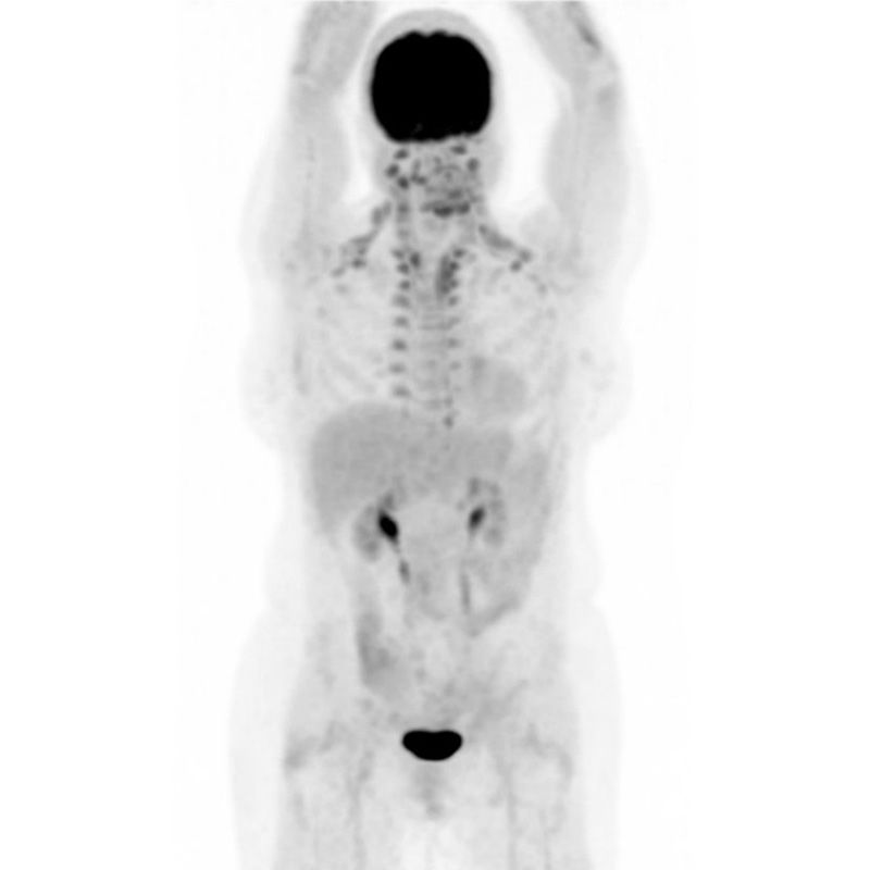 Figure 5: Pet scan three months post-treatment
