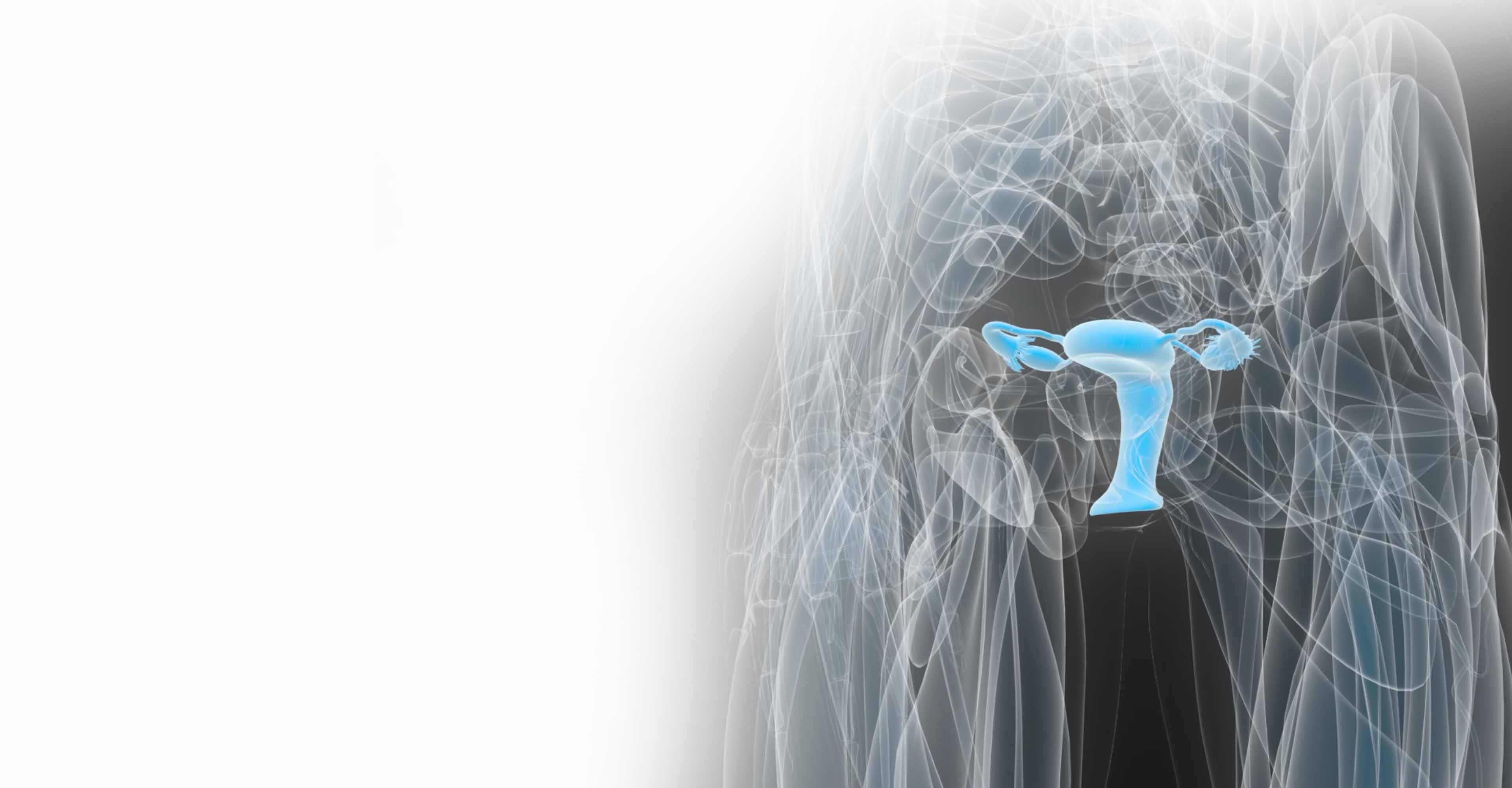 Radiotherapy for gynecological cancer | Elekta