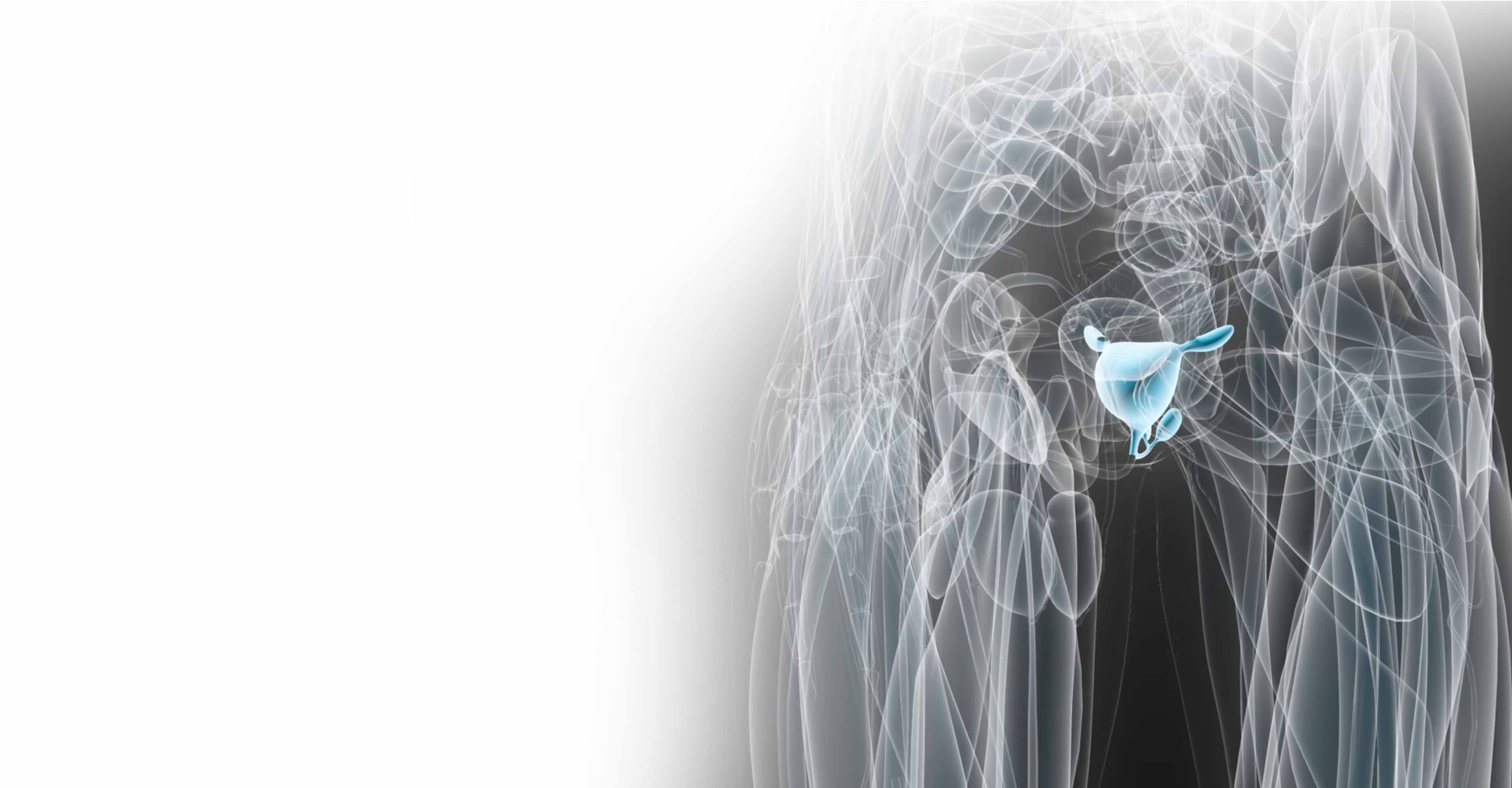Radiotherapy for prostate cancer | Elekta