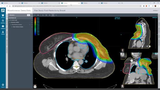 Screenshot of ProKnow CT scan of post-mastectomy breasts page