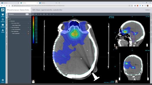 Screenshot of demo brain CT scan on ProKnow
