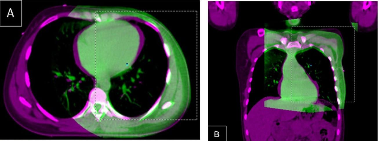 Fusion of Axial and Coronal Ct Slices