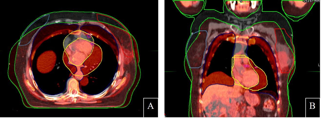 Fusion of Axial and Coronal