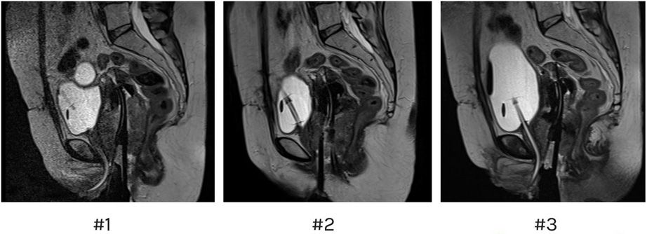 Figure 3: MRI sagittal views of fractions 1-3