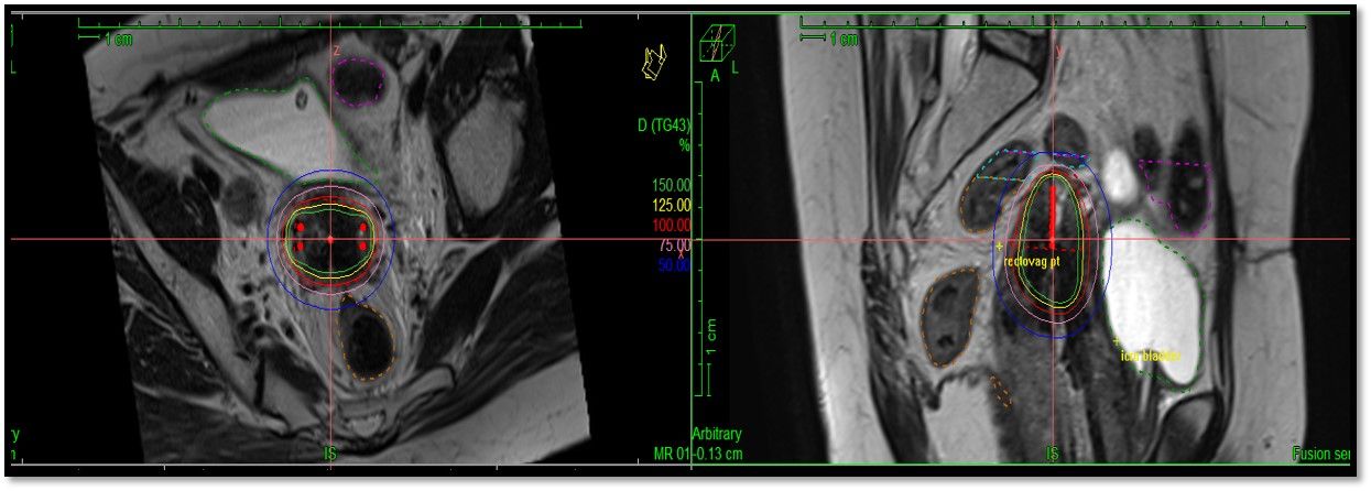 Figure 4: Planning images of ONJ’s first Geneva patient