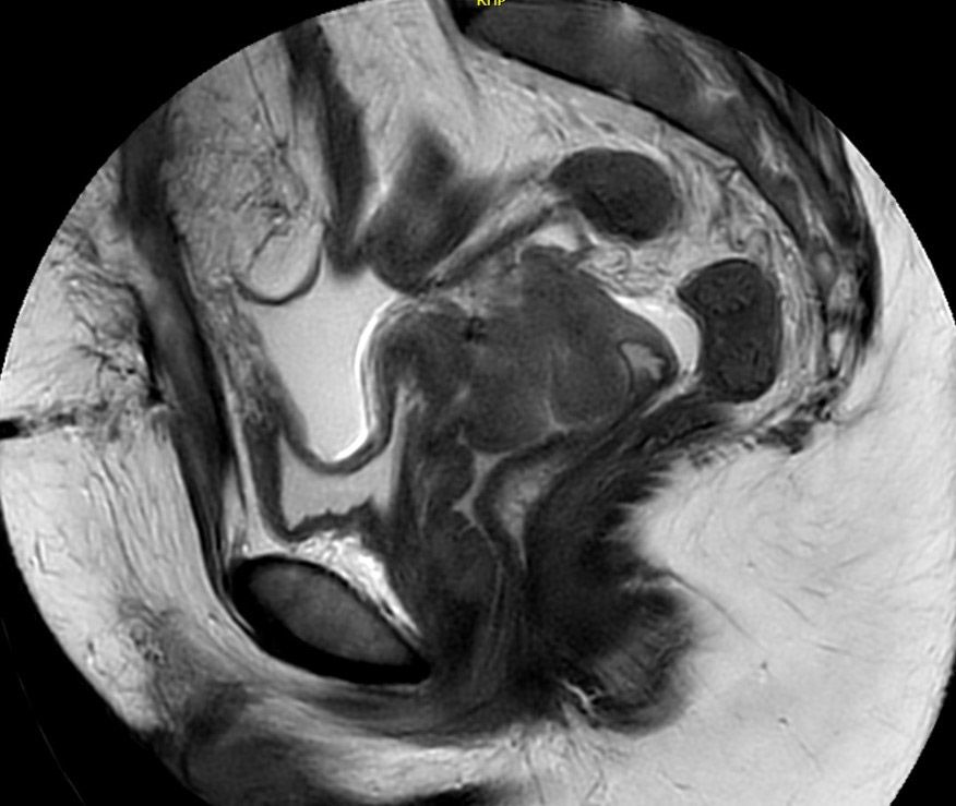 Figure 1: Pre-treatment MRI of ONJ’s first Geneva patient