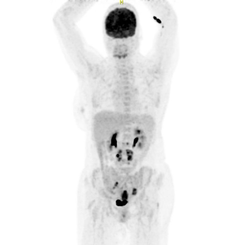 Figure 2: Pre-treatment PET