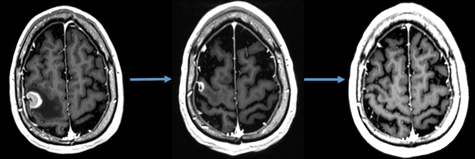 https://www.elekta.com/focus/combining-radiosurgery-with-immunotherapy-improves-outcomes-for-patients-with-brain-metastases/img/brain%20met%20image.png