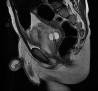 MR image of bladder prostate RMS at diagnosis