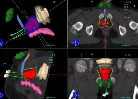 Treatment planning on Oncentra Brachy treatment planning system