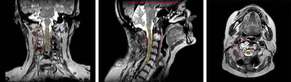 Figure 2. Coronal, sagittal and axial Elekta Unity images of a patient with a chordoma post-resection