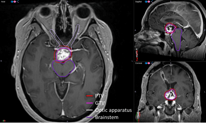 Figure 3. 3.0T MR simulator images of a patient with a craniopharyngioma evaluated for treatment on Elekta Unity in May 2019