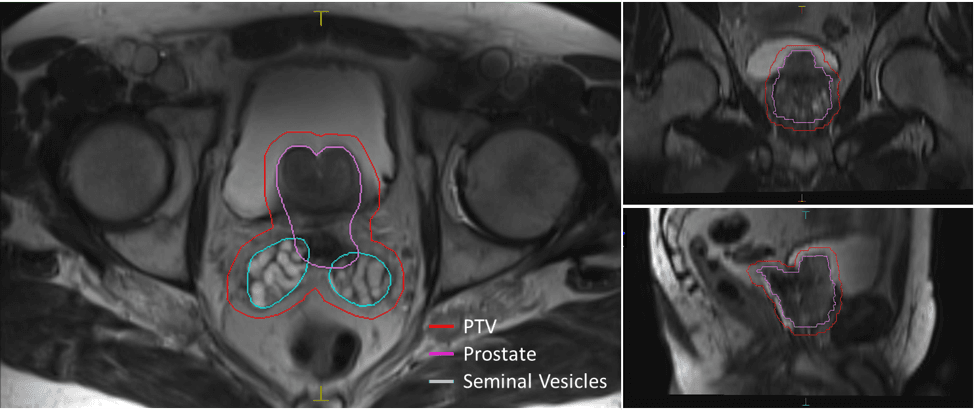Figure 1. T2-weighted prostate images of the first patient treated on Elekta Unity at the University of Iowa