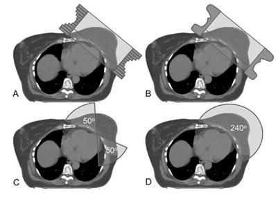 Figure 1. Typical beam arrangements for FinF (A), tIMRT (B), tVMAT (C) and cVMAT (D)