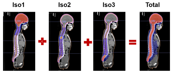 Pediatric Vmat Csi Case, Delivering 23.4 Gy in 13 Fractions, With Boost