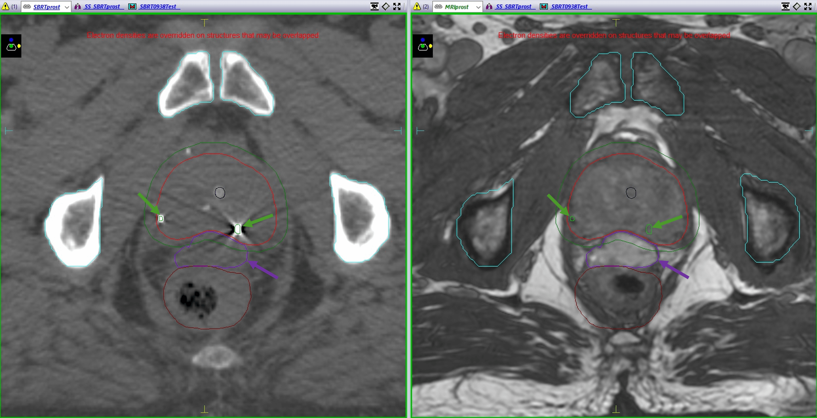 Figure 1. CT (left) and MRI (right) scans showing the positions of 2 gold fiducials (green arrows) and SpaceOAR (purple arrow).