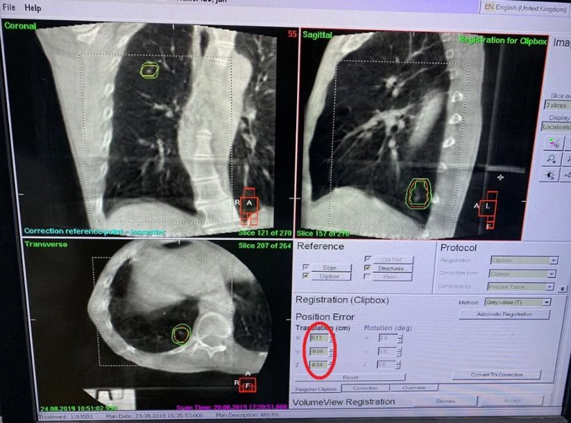 Figure 3. Intra-fraction 3D CBCT image guidance shows errors in X, Y and Z direction of 1.3 mm, 0.8 mm and 0.4 mm, respectively (within tolerance)