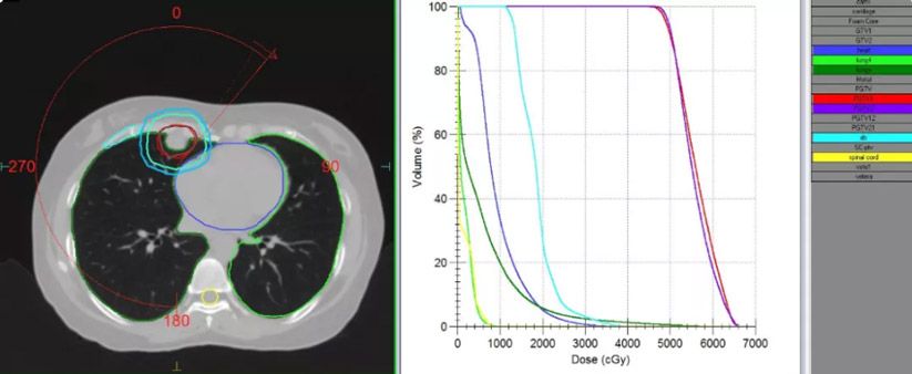 Figure 1. Patient 1 SBRT dose distribution and DVH