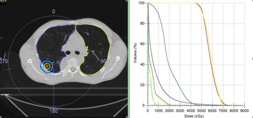 Figure 2. Patient 2 SBRT dose distribution and DVH