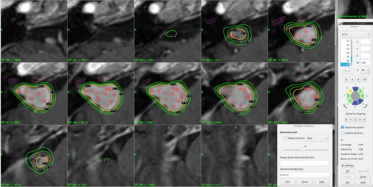 Vestibular Schwannoma Target