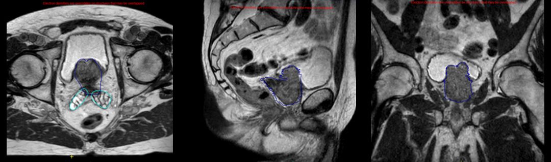 Axial, sagittal, and coronal images acquired on Elekta Unity clearly show the patient’s prostate and surrounding organs at risk.