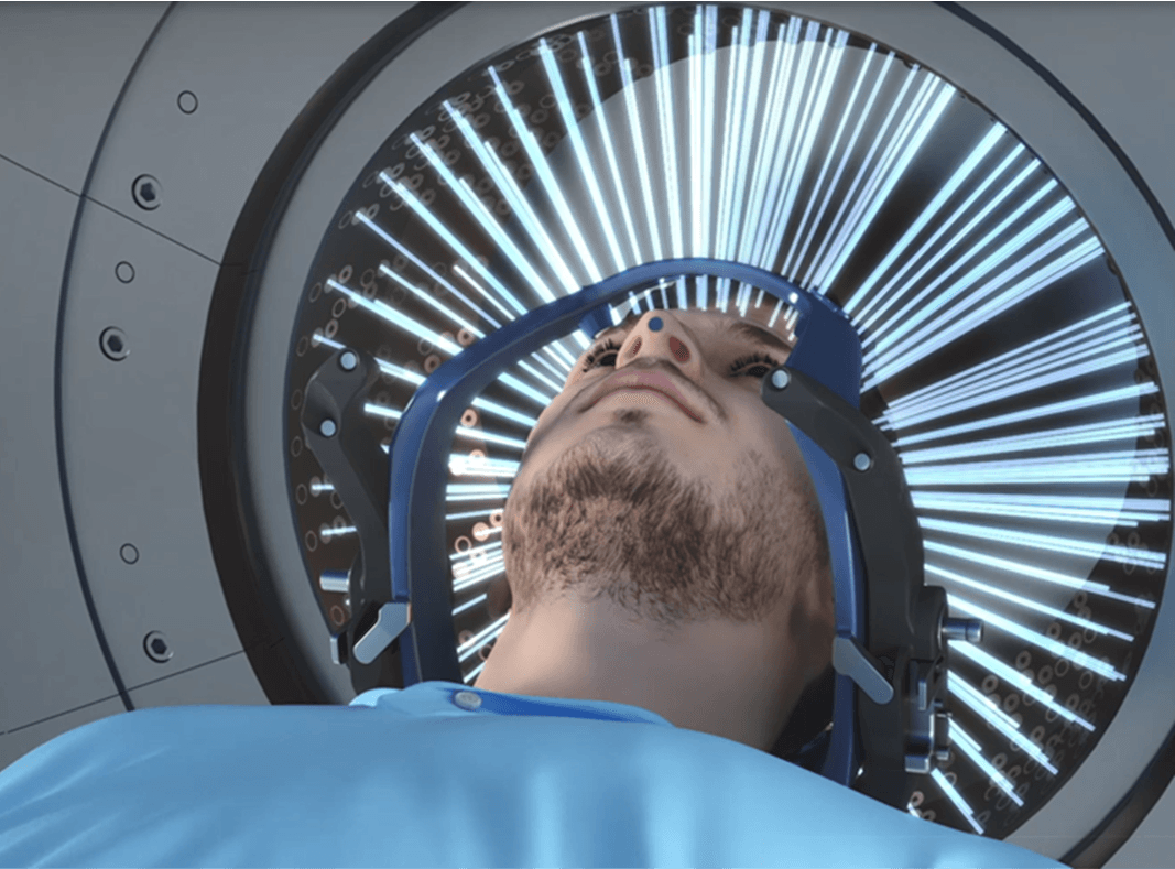 Leksell Vantage Transforming Gamma Knife Radiosurgery Leksell Vantage Transforming Gamma Knife Radiosurgery