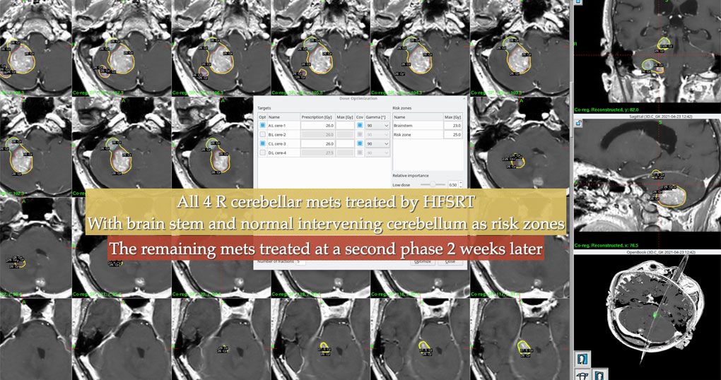 Multiple Brain Mets 6