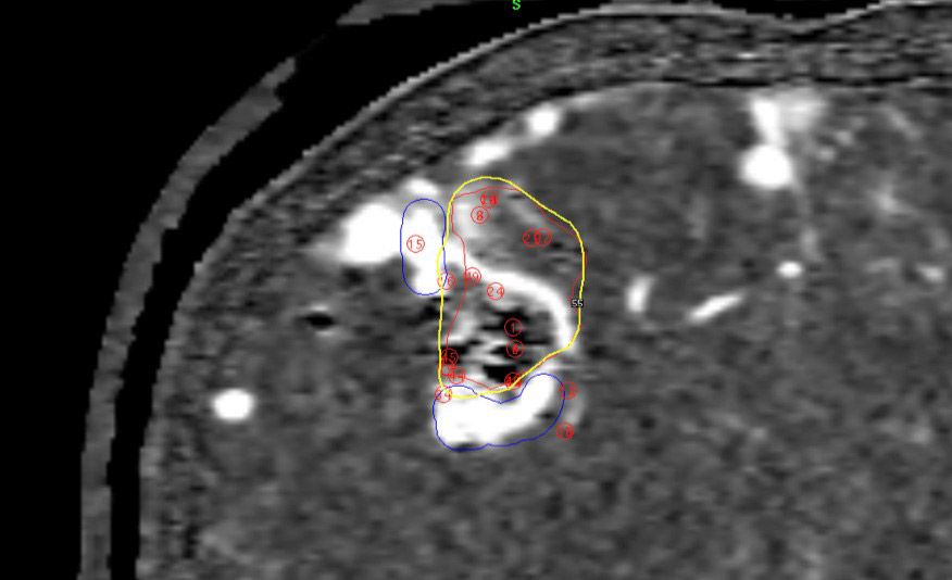 R Parietal Avm