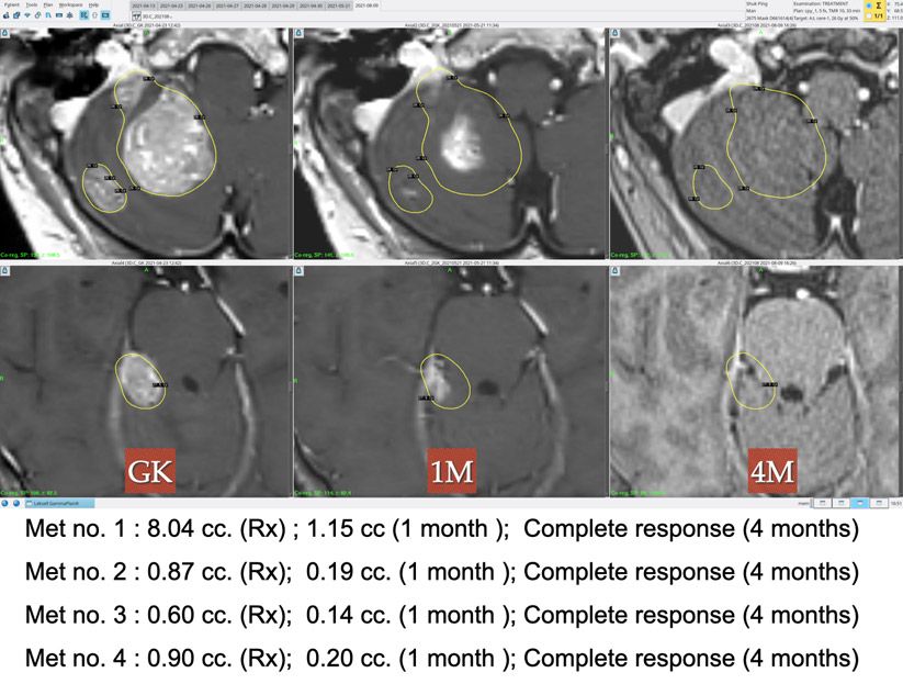 Ca Breast Brain Mets Complete Response