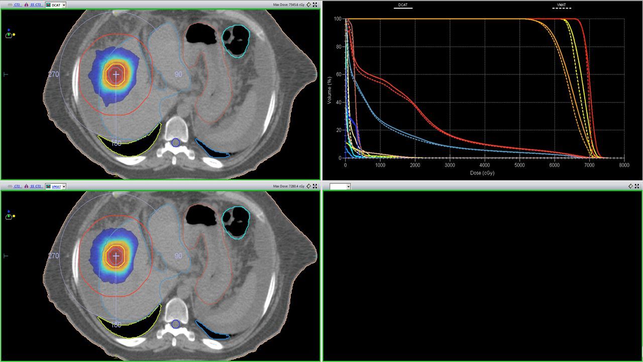 Liver SBRT case. Comparison between DCAT (top) and VMAT (bottom) isodose distributions and DVH (DCAT-solid lines, VMAT dashed lines).