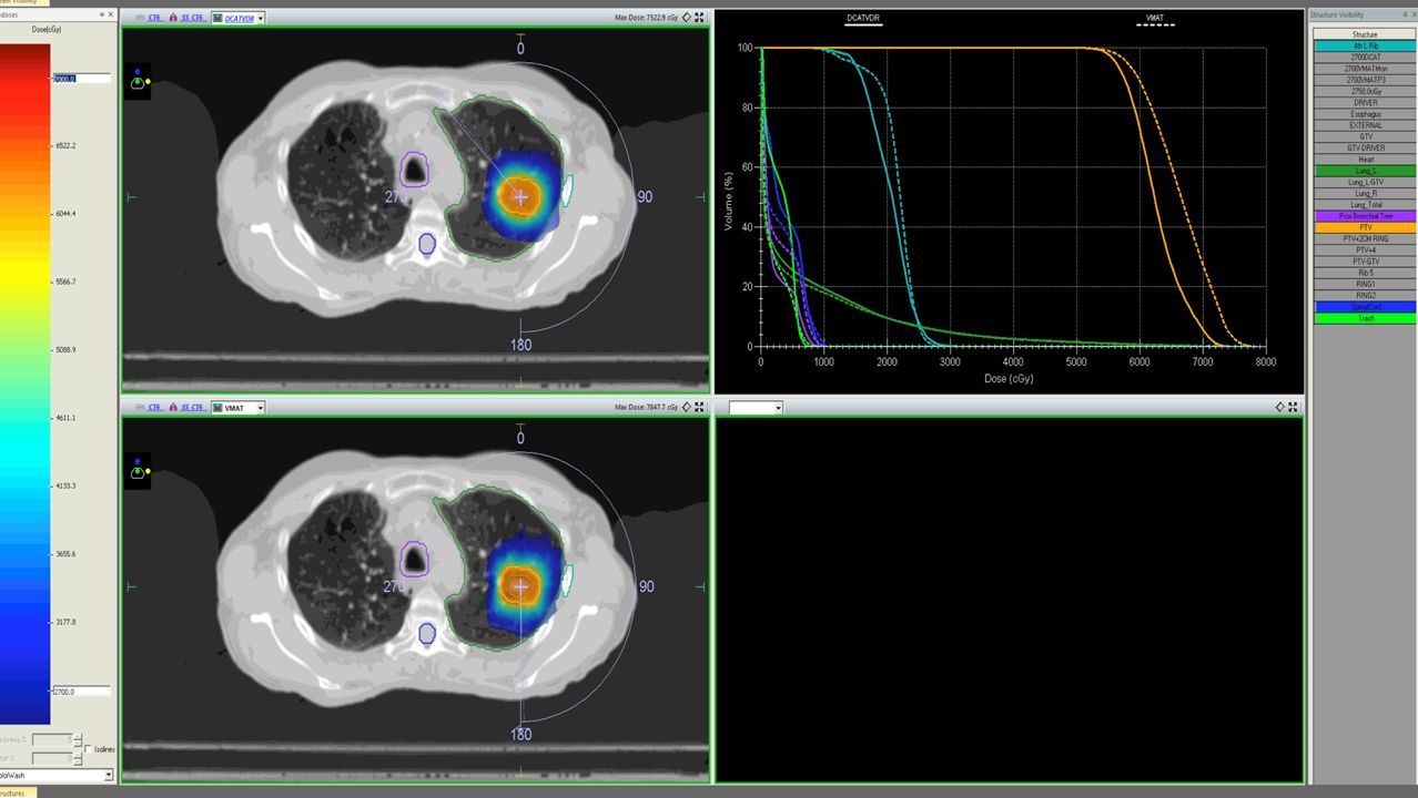Lung SBRT case. Comparison between DCAT (top) and VMAT (bottom) isodose distributions and DVH (DCAT-solid lines, VMAT dashed lines)