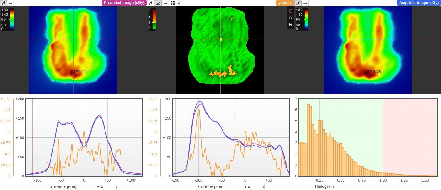 Figure 1. Gamma pass rates for calculated (left) and measured (right) EPID dosimetry for a head and neck patient, showing good agreement (97%) between the predicted and acquired models (center).