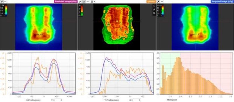 Figure 3.1. Ep Ibeam Detects Introduced Mlc Errors Head and Neck Vmat Plan