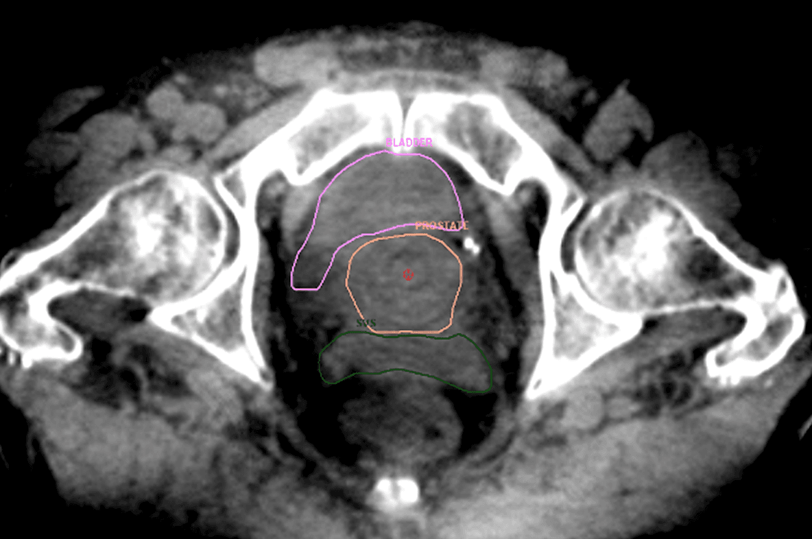 Prostate and Sminal Vesicle