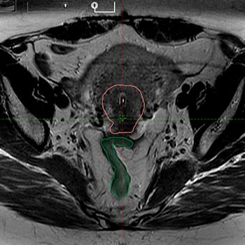 Case 1 Upper Left