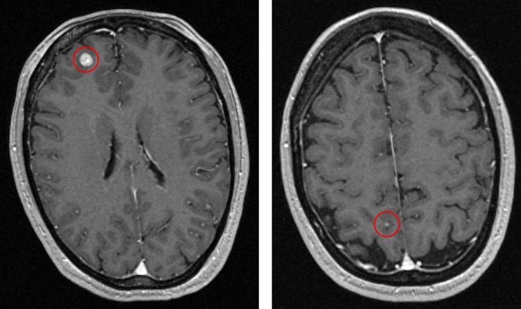 Right lobe metastasis