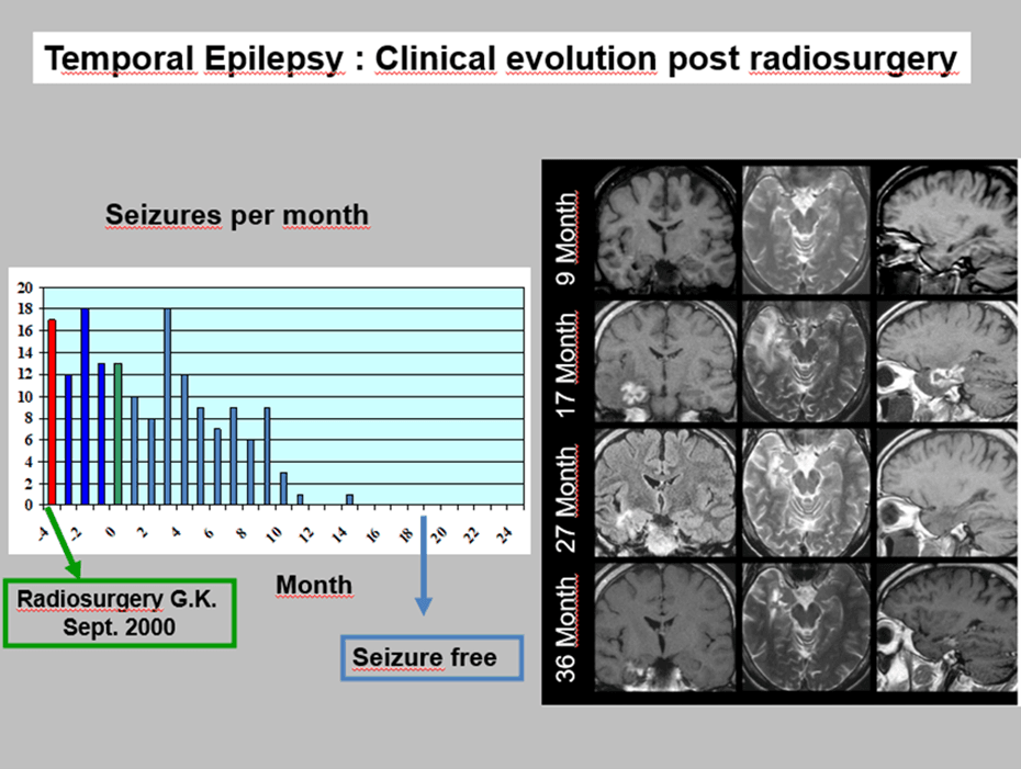 Clinical Evolution Post Lgk Srs in Mtle Cases