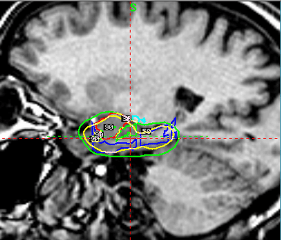 Treatment Plan for Mtle Case Example 1