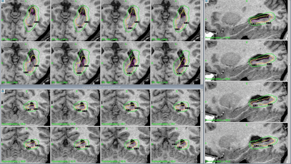 Treatment Plan for Extratemporal Epilepsy Case Example 1