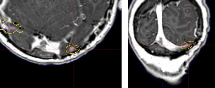 Left occipital