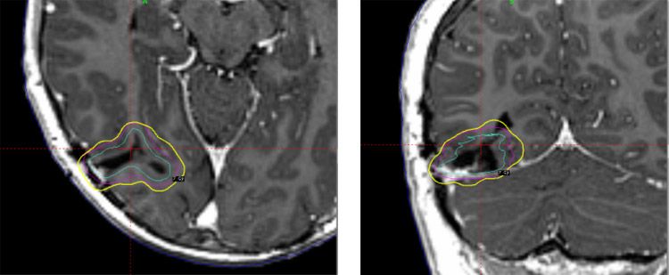 Right occipital