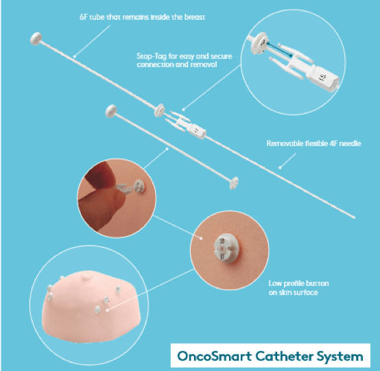 OncoSmart catheter system