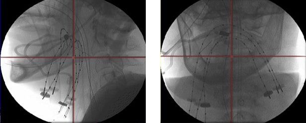 X-ray image of flexible catheters with X-ray markers