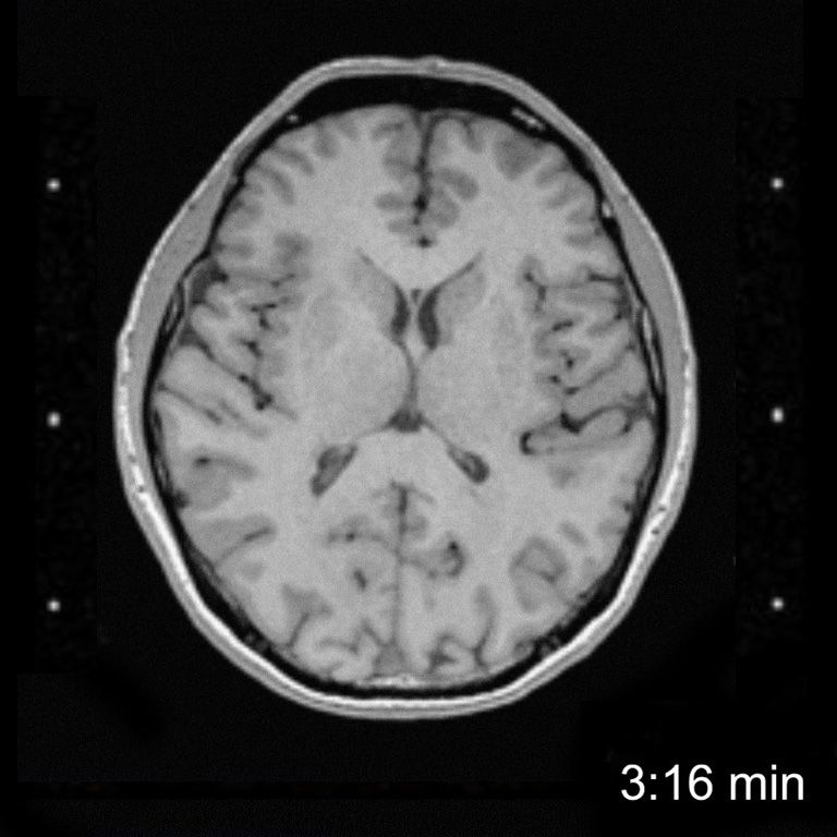 MRI Scan comparison