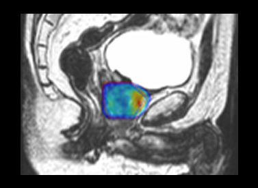 Recurrent Prostate Re-treatment