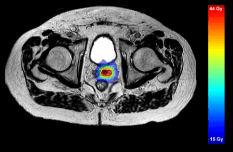 1.5 T Mri