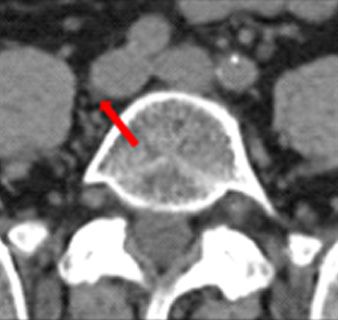 T2W MRI on Elekta Unity MR-Linac