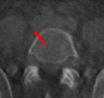 T2W MRI on Elekta Unity MR-Linac