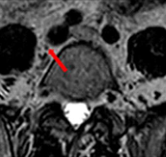 T2W MRI on Elekta Unity MR-Linac