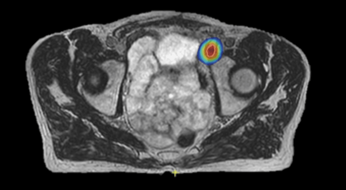 Highly conformal dose on T2W MRI (Elekta Unity MR-Linac)